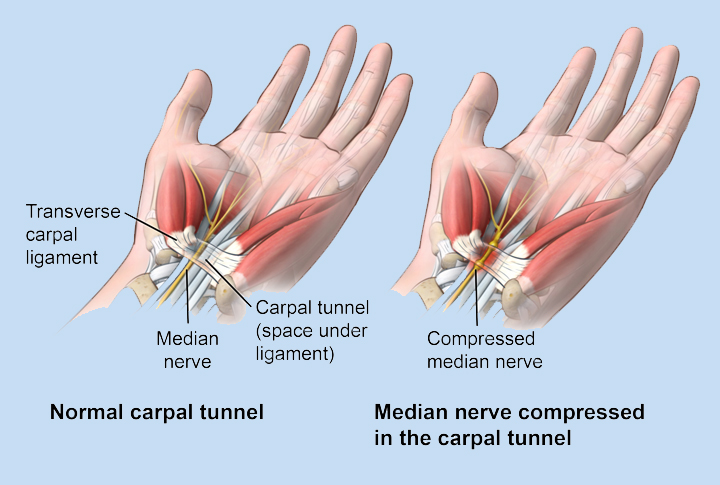 Help! I Think I Have Carpal Tunnel Syndrome